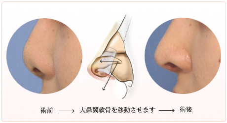 短い鼻や低い鼻を治すには