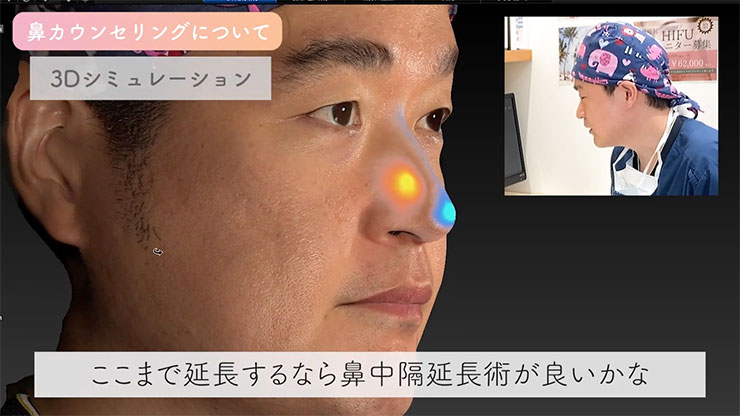 鼻整形の3Dシミュレーション