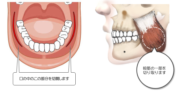 咬筋切除