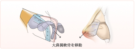 鼻中隔軟骨の先端に軟骨を縫いつけ、大鼻翼軟骨を移動