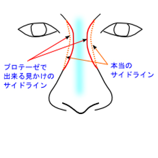 鼻のプロテーゼのサイドラインの見え方の効果