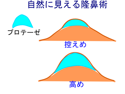 自然に見える隆鼻術