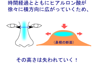 ヒアルロン酸注入の切らない鼻整形