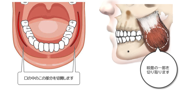 咬筋切除