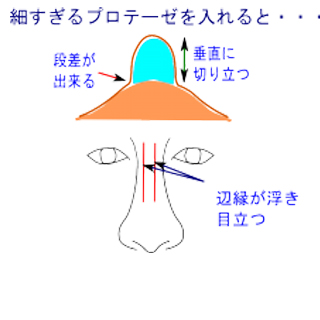 鼻のプロテーゼが細すぎる場合