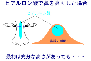 ヒアルロン酸注入の切らない鼻整形