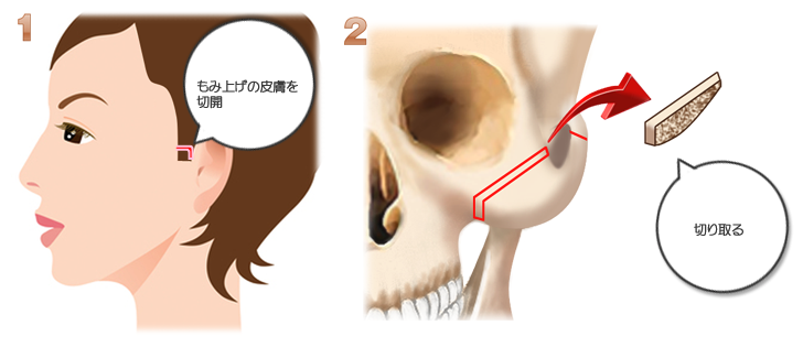 頬骨形成（頬骨削り）