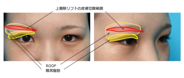 上眼瞼リフト ROOF 切除