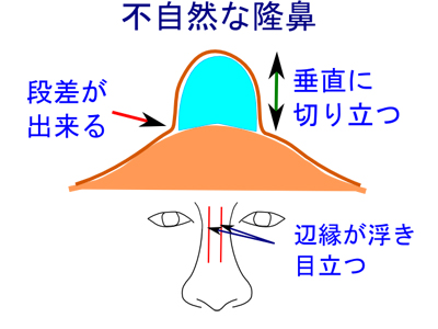 不自然な隆鼻術とプロテーゼ