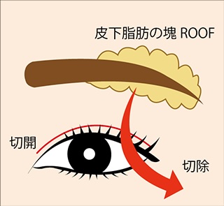 皮下脂肪の塊 ROOF