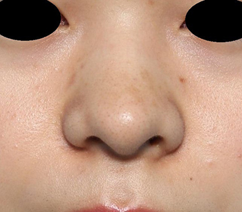 鼻翼縮小 美容整形 美容外科のヴェリテクリニック 公式 東京 名古屋 大阪