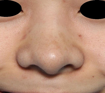 鼻翼縮小 美容整形 美容外科のヴェリテクリニック 公式 東京 名古屋 大阪