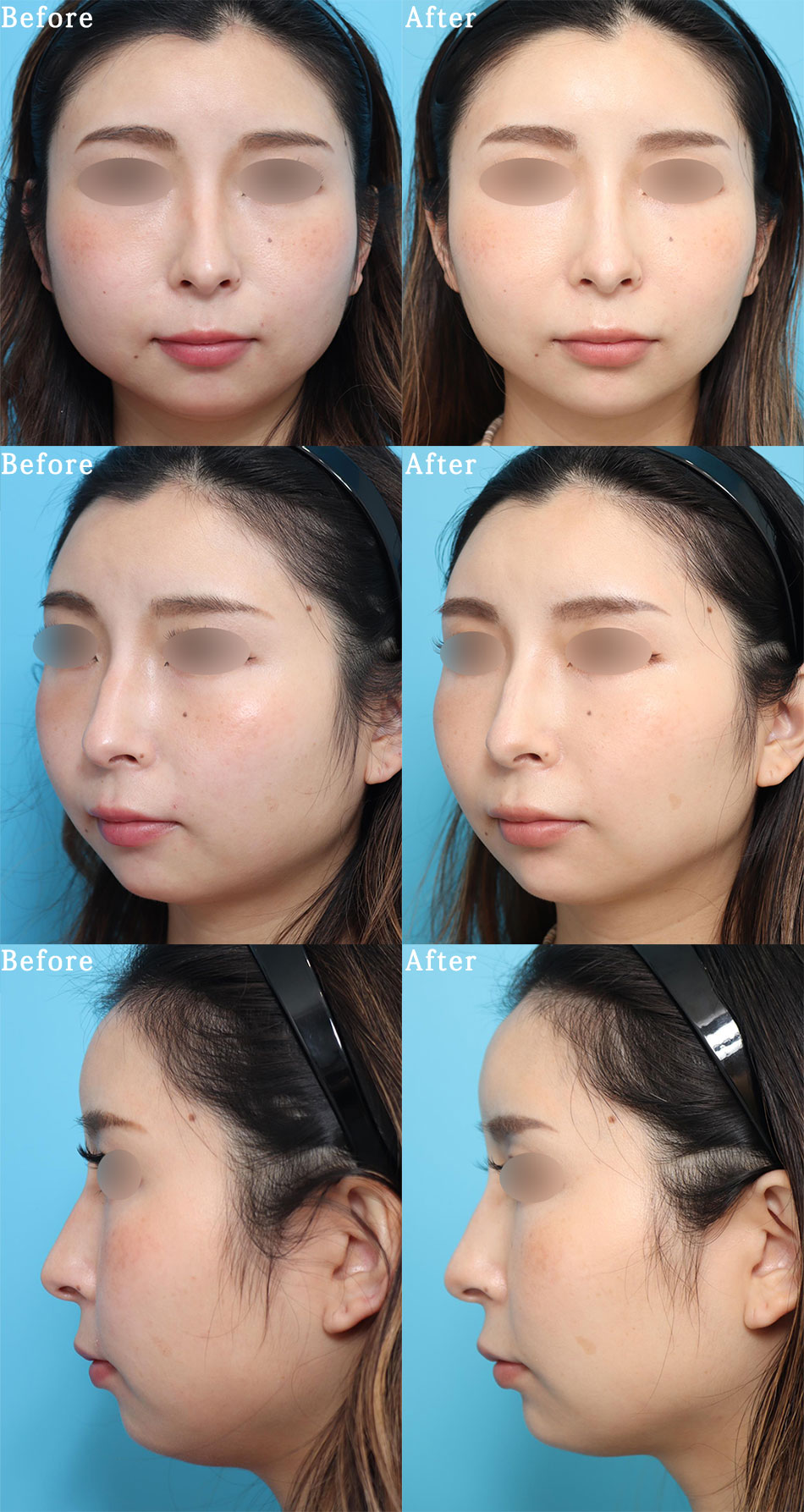 エラボトックス 小顔形成 美容整形 美容外科のヴェリテクリニック 公式 東京 名古屋 大阪