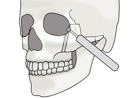 頬骨セットバックの術式