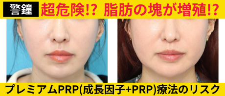 （手術シーンあり）超危険！？プレミアムPRP療法（成長因子＋PRP）のリスク